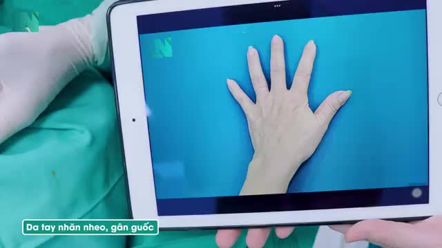 45 phút là khoảng thời gian để thực hiện  cấy mỡ trẻ hóa đôi bàn tay.