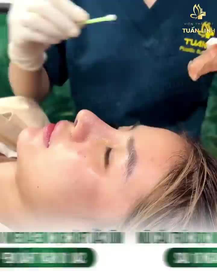 Dáng mũi cấu trúc bọc  Megaderm sau 10 ngày.