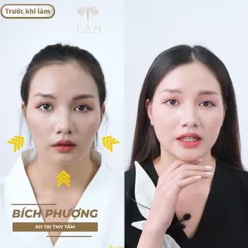 "Mình rất tự ti về khuôn mặt của mình, má hóp, cằm ngắn. Sau khi thực hiện combo Filler tại Tấm, mình đã trở nên tự tin hơn rất nhiều. Giờ đây, mình có thể tự tin diện những bộ đồ mình yêu thích, chụp ảnh và giao tiếp với mọi người."