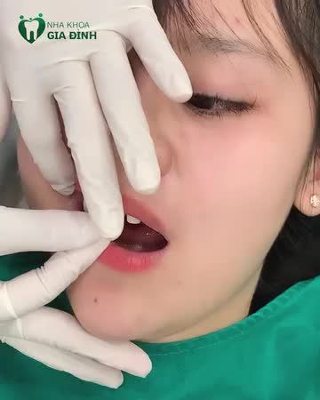 "SAY BYE" HÀM RĂNG XẤU CHỈ TỪ 1TR/RĂNG. ĐẶT LỊCH NGAY HÔM NAY!!!