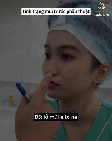Nâng mũi cấu trúc Surgiform - Khách hàng đến từ Bến Tre!