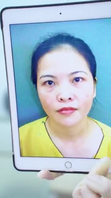 Combo trẻ hóa mí mắt toàn diện nâng cung mày + Nâng mũi vừa thực hiện xong trông sẽ như thế nào? Theo dõi ngay