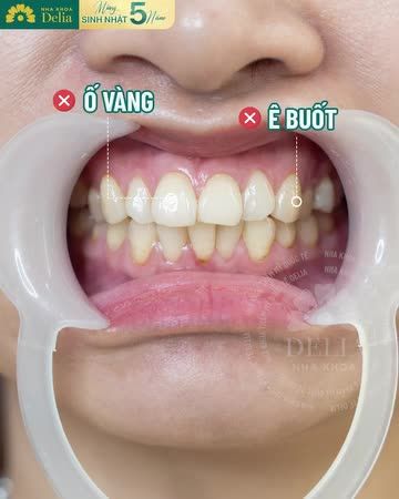 Nụ cười mới đều đẹp, trắng sáng đã giúp chị Hiền chấm dứt tình trạng ê buốt trước đó và lấy lại sự tự tin trong giao tiếp