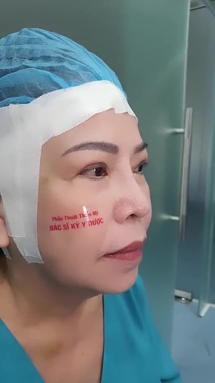 Đầu mũi cao bay, thon gọn  Sống mũi tự nhiên, hài hòa với tỷ lệ gương mặt Lỗ mũi cân đối