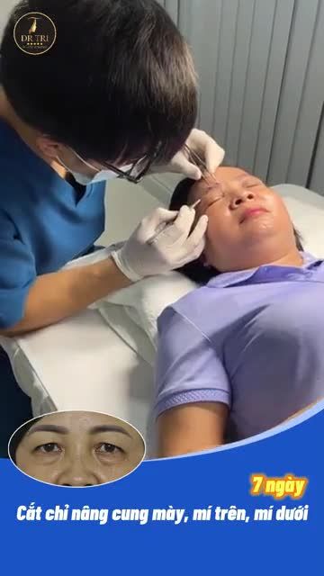 TÁI KHÁM CẮT CHỈ CHO CA MÍ TRÊN, MÍ DƯỚI, NÂNG CUNG MÀY