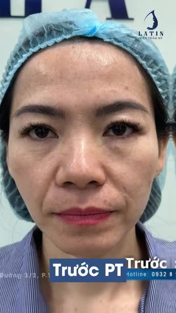 Sự kết hợp hài hòa giữa hai phương pháp tạo nên gương mặt đầy đặn, tự nhiên và trẻ hóa.