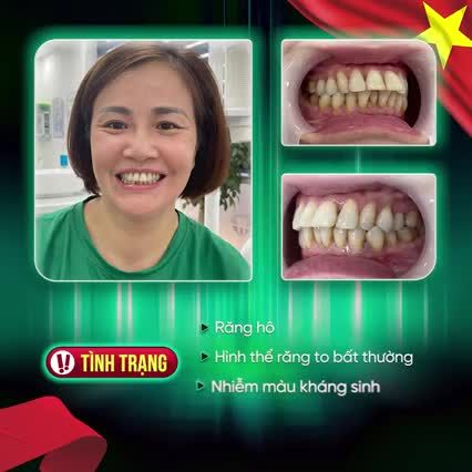 GẶP ĐÚNG NHA KHOA - HOANG MANG BỖNG HÓA NHẸ NHÀNG