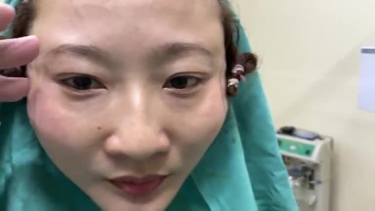 Tạo “mắt cáo” & căng da thái dương, mặt với Dr Vương