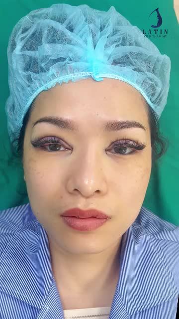 Kết quả cắt mắt 2 mí kết hợp mở góc mắt trong của chị khách hàng đẫ từng sử dụng dịch vụ làm đẹp khác tại Latin