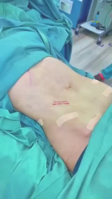 Trước Phẫu thuật:   - Bụng to, mỡ thừa nhiều, da dư chảy sệ. Sau phẫu thuật: - Vòng eo thon gọn, loại bỏ toàn bộ mỡ thừa. Mời cả nhà cùng so sánh hình ảnh trước và sau nha.