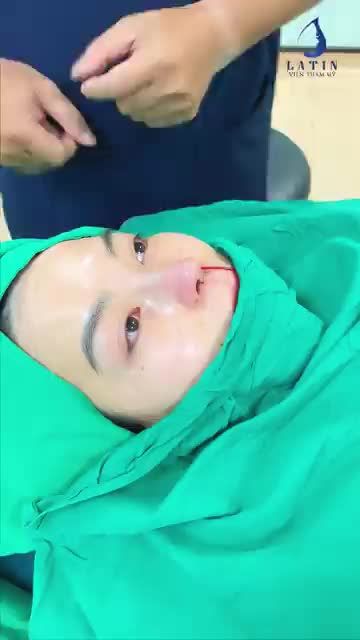 Chị khách đến từ Đồng Nai, lần đầu tiên nâng mũi và lựa chọn của chị là Latin.