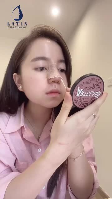 Trải nghiệm 10 ngày NÂNG MŨI cùng hot TikToker Phan Ngân Hà!