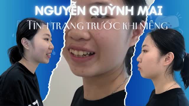 Cảm xúc dâng trào sau khi tháo niềng răng - Hoàn thành một chặng đường dài!