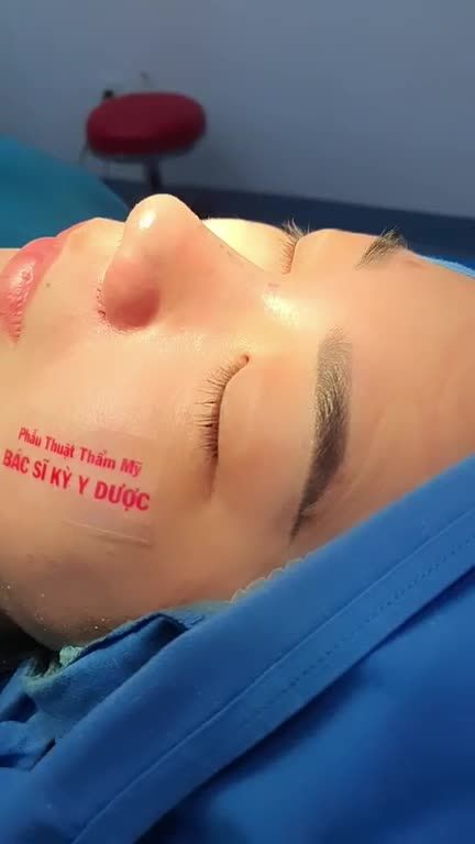 Thay đổi chỉ sau hơn 60 phút Nâng Mũi ALINE do chính tay Bác sĩ Kỳ thực hiện: