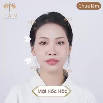 TRẢI NGHIỆM SỰ THAY ĐỔI CHỈ SAU 30 PHÚT VỚI FILLER TẠI TẤM