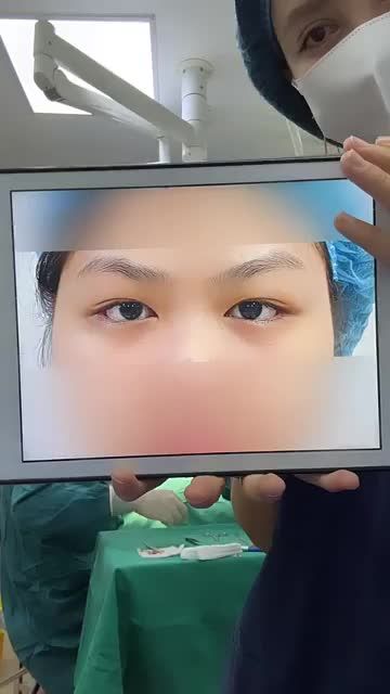 Tại sao bên Hàn phẫu thuật mí có thể còn đắt hơn phẫu thuật Ngực hay Mũi ????