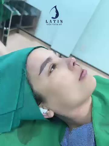 Combo mũi cấu trúc + nâng cung mày đa tầng vừa hoàn thành