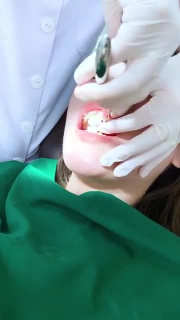 THÁO MẮC CÀI NIỀNG RĂNG CHO MỘT NỮ KHÁCH HÀNG XINH ĐẸP