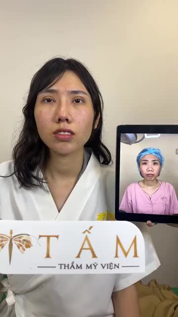 Cảm ơn chị khách đã tin tưởng lựa chọn dịch vụ làm đẹp bên Tấm. Mọi người cùng theo dõi livestream để thấy được sự thay đổi đáng giá của chị khách khi sử dụng combo filler cằm, rãnh cười + cắt mí, mở góc  trong + nâng mũi, thu cánh mũi nhé.