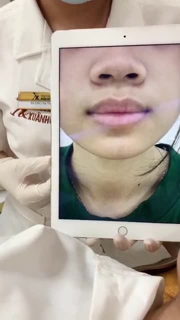 Tạm biệt môi thâm xỉn chỉ sau 1 liệu trình