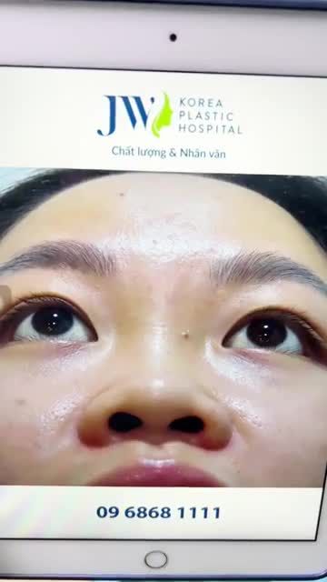 NÂNG MŨI SLINE 3D chị gái U30 hóa MỸ NHÂN tự tin với dáng mũi ĐẸP TỰ NHIÊN chuẩn châu Á tại JW