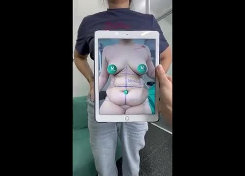 Thay đổi toàn diện, không còn mỡ thừa, da trùng, không lộ dấu vết thẩm mỹ là những gì khách hàng nhận được sau khi thực hiện combo Hút mỡ tạo hình bụng tại Dr. Minh Phạm.