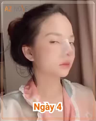 TẠI SAO ĐÂY LÀ THỜI ĐIỂM TỐT NHẤT ĐỂ NÂNG MŨI ĐÓN TẾT?