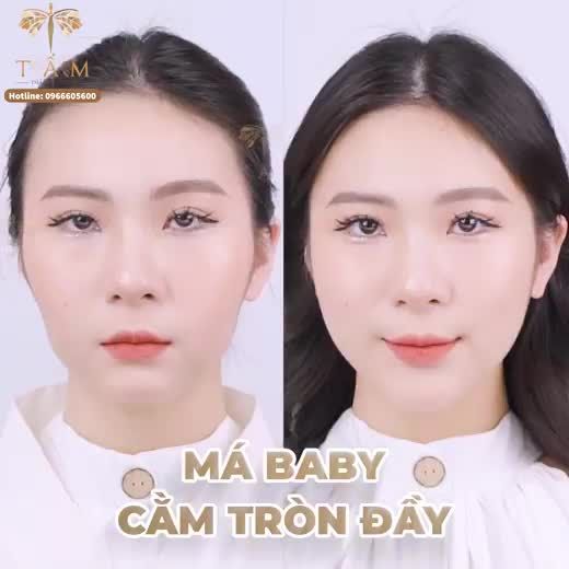 Bạn muốn có gương mặt tươi trẻ, tràn đầy sức sống mà không phải trải qua nỗi đau của phẫu thuật thẩm mỹ? Filler Má Cằm tại Tấm sẽ giúp bạn vượt qua nỗi sợ và mang đến vẻ đẹp tự nhiên hoàn hảo.