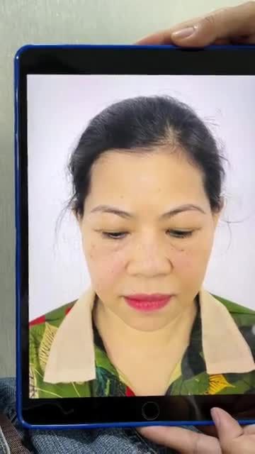 Tái khám cắt chỉ tạo hình mí cho cô khách