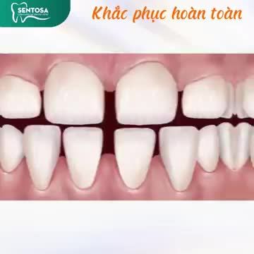 NIỀNG RĂNG GIÁ HỜI - LÊN ĐỜI NHAN SẮC