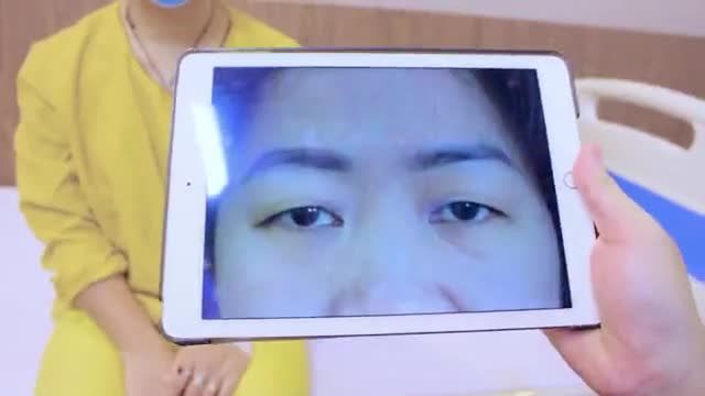 Đôi mắt u buồn sau cắt mí trông sẽ như thế nào? Theo dõi ngay