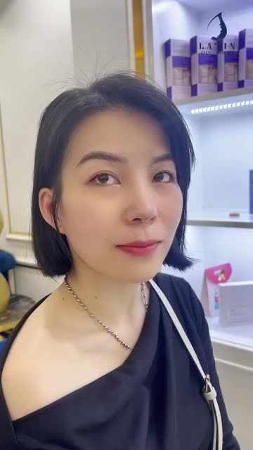 MŨI CẤU TRÚC SURGIFORM 12 NGÀY CẮT CHỈ