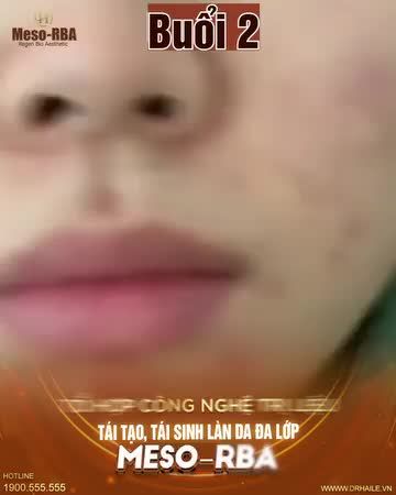 Chấn động : cô gái không nhận ra mình vì làn da cải thiện rõ rệt chỉ sau 1 liệu trình thực hiện Meso RBA