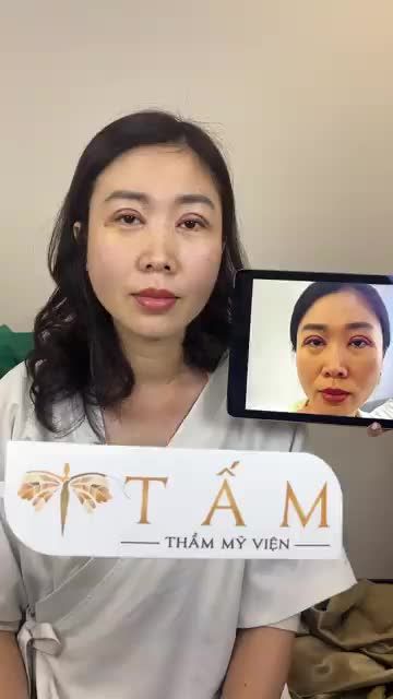 Cận cảnh ca cân chỉnh má, cằm, rãnh cười cho chị khách hàng tại phòng khám TMV Tấm. Cùng Tấm phân tích hình ảnh của chị khách trước và sau khi làm dịch vụ dưới đây nhé
