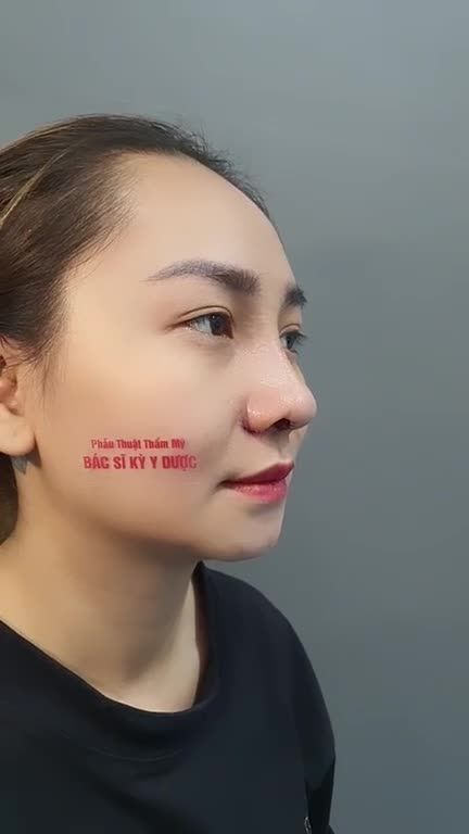 Bạn đang muốn có một chiếc mũi hoàn hảo?