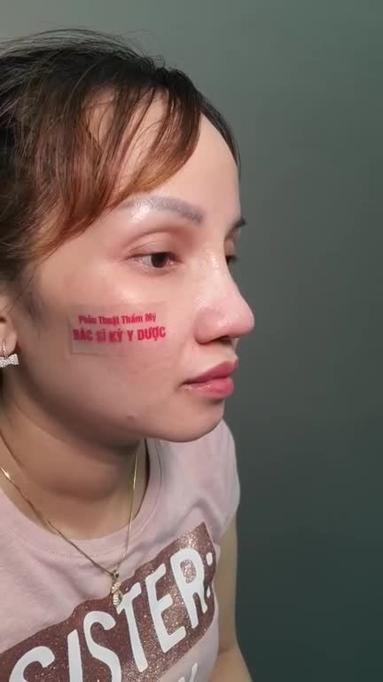 Hành trình hoá thay đổi bản thân với Nâng Mũi ALINE của bạn khách.