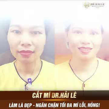 Sở hữu đôi mắt 1 mí, mí lót khiến bạn cảm thấy tự ti về tính thẩm mỹ trên gương mặt của mình, luôn cảm thấy bản thân "kém thu hút"?