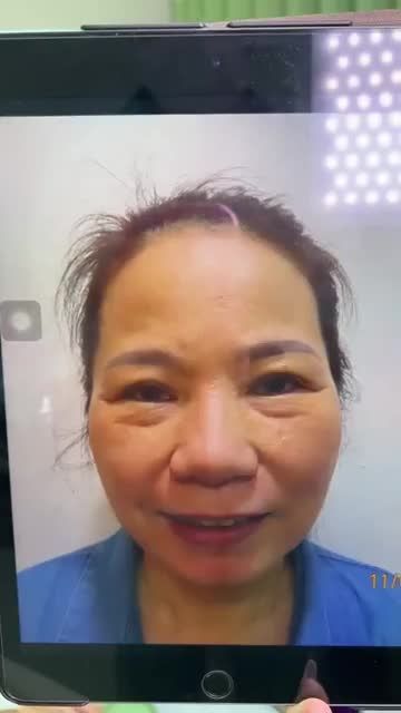 Quý cô U60  đến từ Mỹ CHI TIỀN MẠNH TAY để trẻ hóa toàn diện gương mặt với TREO CHÂN MÀY + MIDFACE 3IN1 tại JW