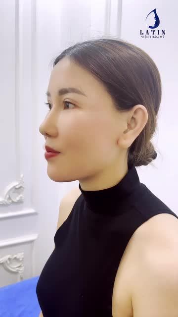 Chị gái sau hơn 1 năm sửa mũi quay lại Latin tái khám vô cùng hài lòng vì dáng mũi mới không chỉ giúp chị xinh đẹp hơn mà còn gặp nhiều may mắn, mọi chuyện thuận lợi hơn.