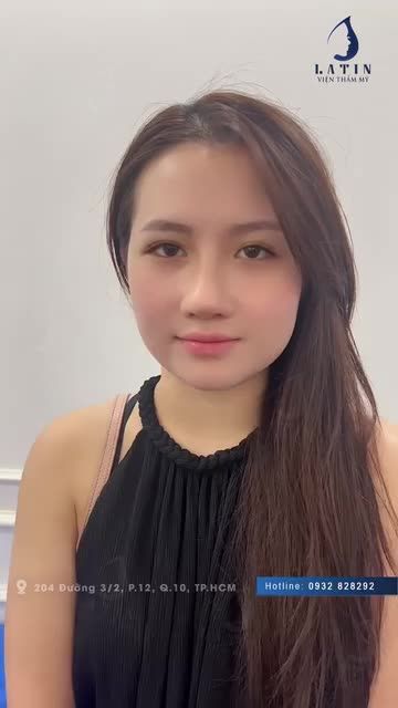 Mũi cấu trúc SURGIFORM cho em gái từ Mỹ về 11 ngày QUÁ XINH!!!