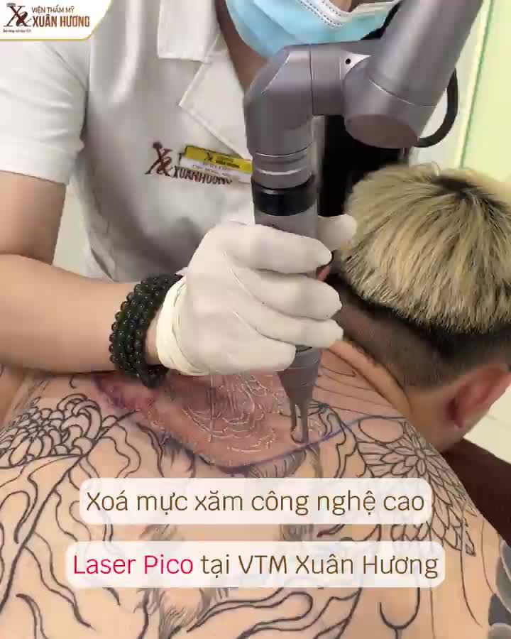 KIỂM CHỨNG KẾT QUẢ XÓA XĂM SẠCH MỰC, KHÔNG SẸO TẠI XUÂN HƯƠNG
