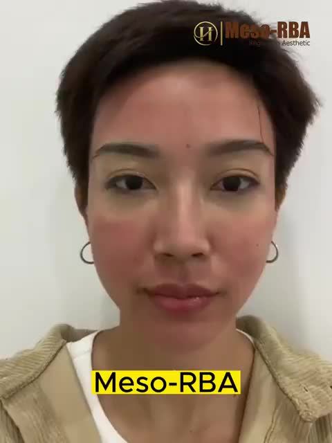 Meso-RBA Dr.Hải Lê: Da sáng mịn, thêm phần tự tin!