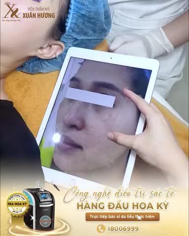Khách hàng bị nám đã nhiều năm, nhiều nốt to đậm màu ở vùng má và đang có dấu hiệu lan sang các vùng khác trên mặt.