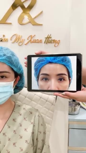 Thái dương hóp lõm, biện pháp nào là hiệu quả nhất