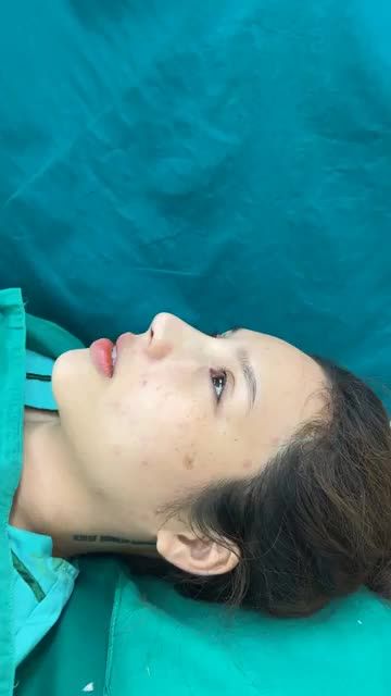 Case mũi bọc sụn vừa hoàn thành