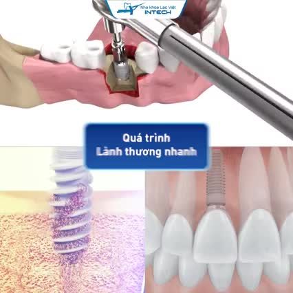 Chỉ 15 phút khôi phục răng mất - Bền chắc trọn đời