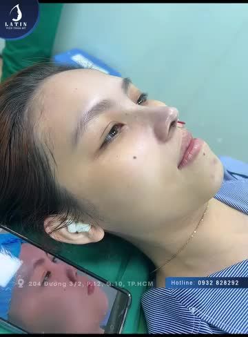 Em gái Sóc Trăng xinh đẹp hơn sau khi nâng mũi cấu trúc
