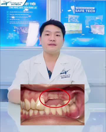 Công nghệ phục hình răng sứ trên implant tái tạo mô lợi như thế nào?