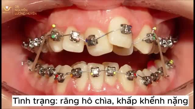 Răng hô, chen chúc, khấp khểnh nặng