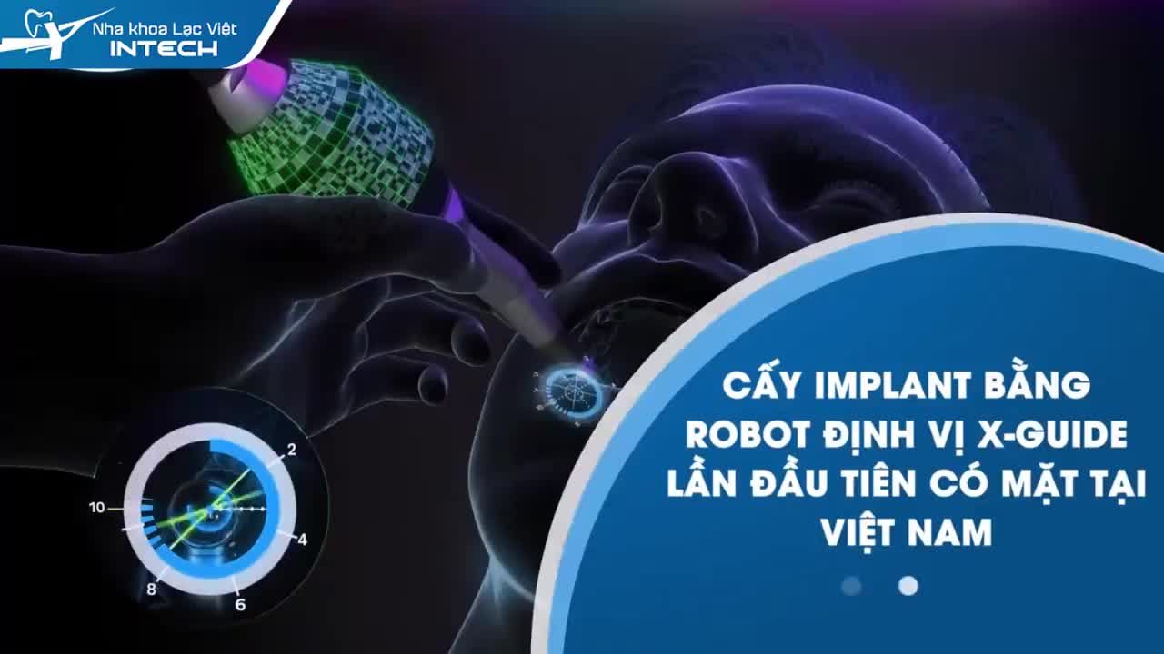 Trồng răng implant bằng Robot định vị - giải pháp trồng implant chính xác số 1 trên toàn cầu.